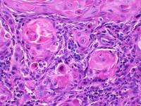 cancerous oral tissue
